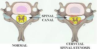 spinal-canal