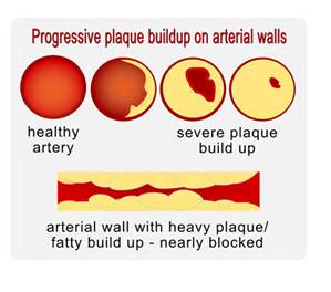 artery-plaque