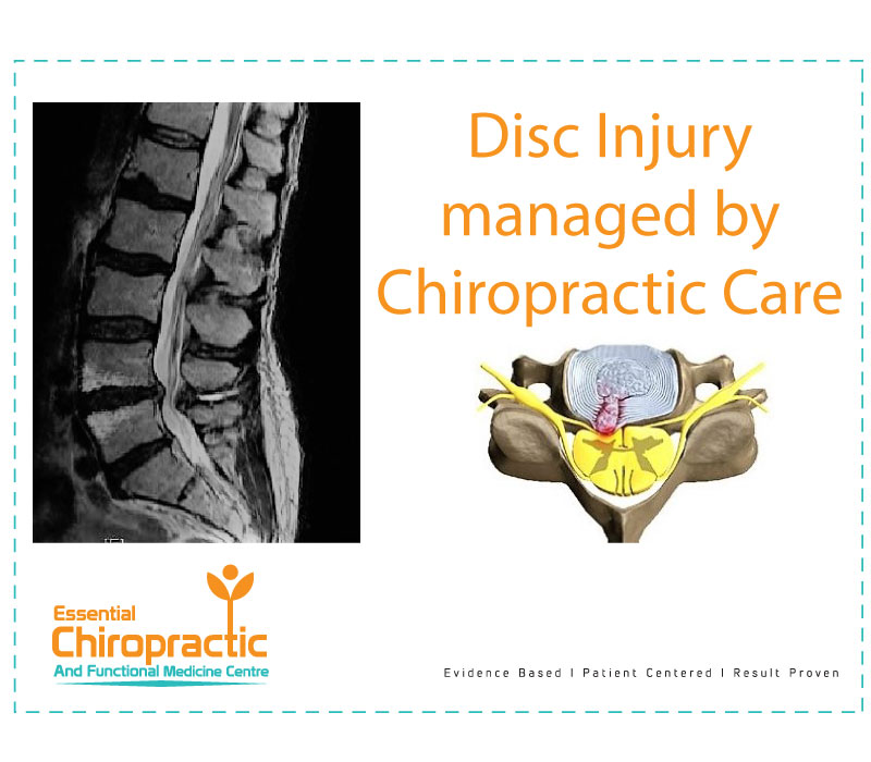 Chiropractic Helps With Disc Herniation