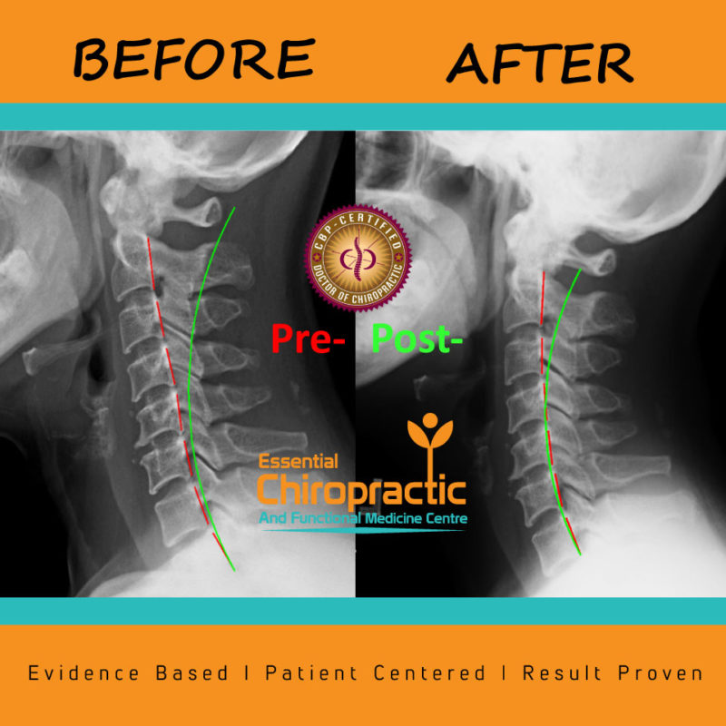 Pain free with Corrective Spinal Care