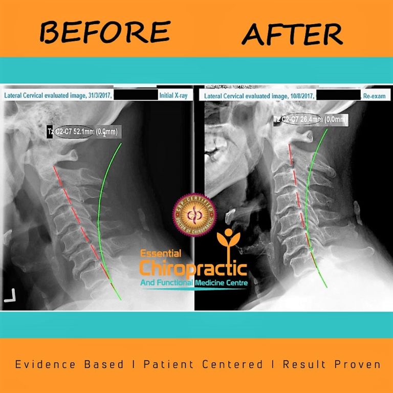 Spinal Arthritis With Corrective Chiropractic Chiropractic Biophysics